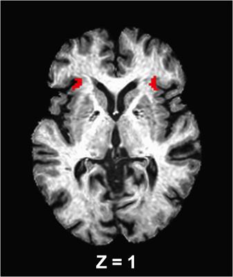 Subjective Well-Being and Bilateral Anterior Insula Functional Connectivity After Exercise Intervention in Older Adults With Mild Cognitive Impairment